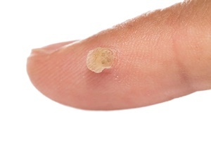 A wart is a skin disease which have been successfully battling the Skincell Pro