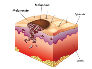 The mole is a natural formation, which can be removed with the use of the Skincell Pro
